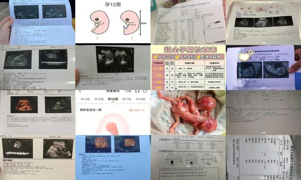 汕头怀孕12～16周需要检查什么