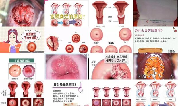 汕头宫颈糜烂 不孕不育