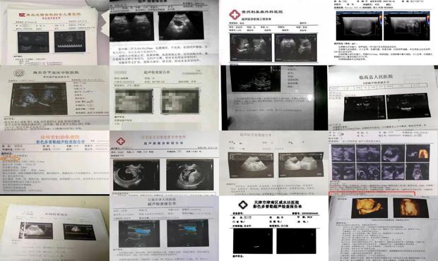 汕头孕检超声检查报告