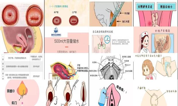 汕头坐月子女性阴道口松弛下坠怎么办